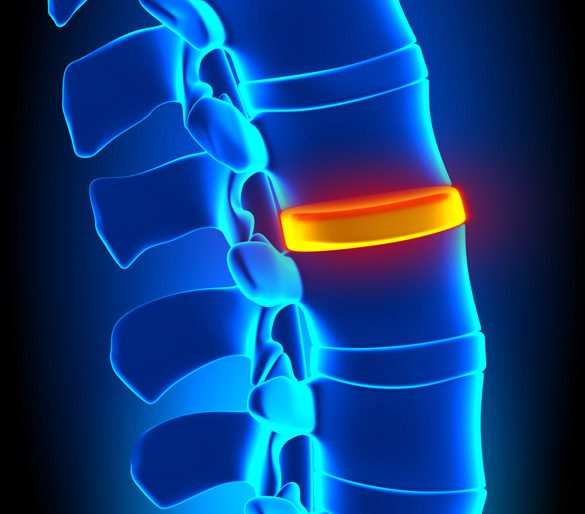 Minimally-Invasive-Spinal-Surgery-(Microdisc-Fusion)-MiSurgical