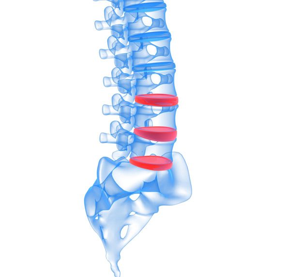 Percutaneous-Disc-Decompression-MiSurgical