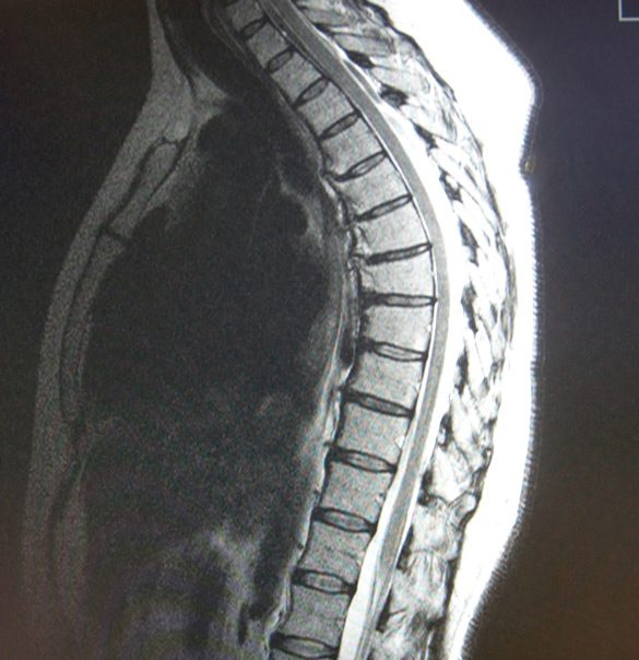 Percutaneous-Disc-Decompression-MiSurgical