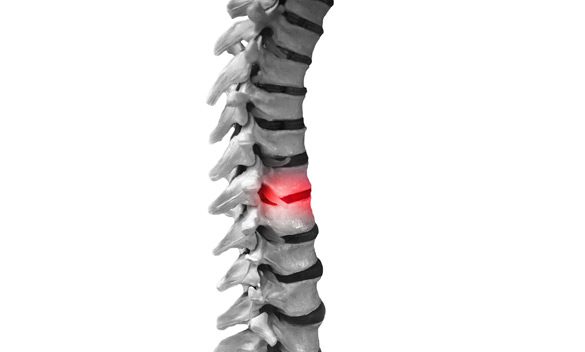 Spinal-Cord-Stimulation-Trial-&-Lead-(Nevro-New-Revolutionary-Technology)-MiSurgical